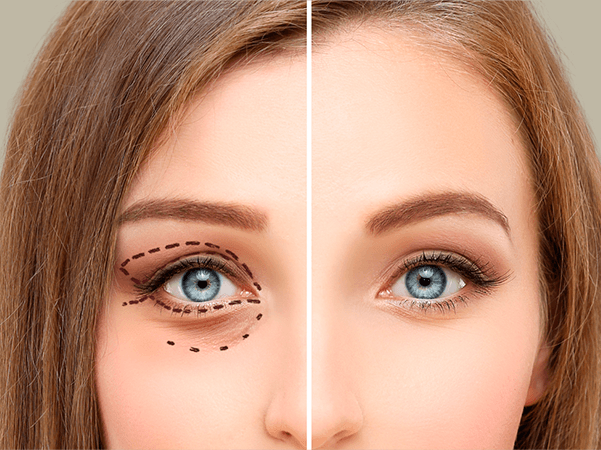 blefaroplastia_tema