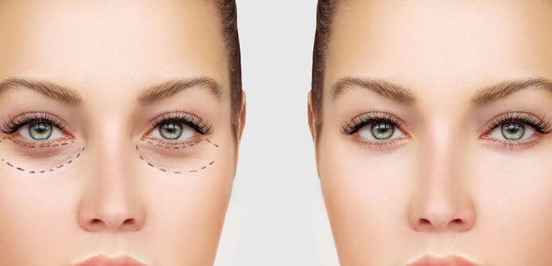 marking-the-face-lower-eyelid-blepharoplasty